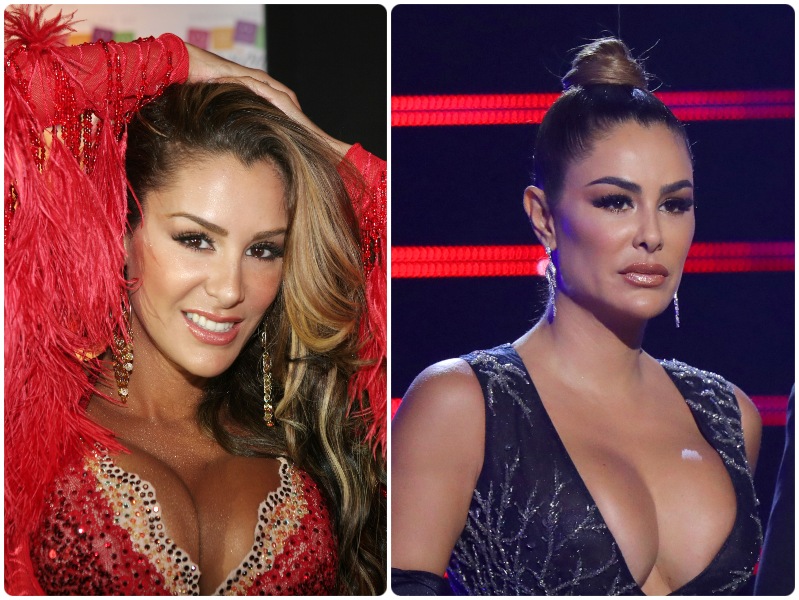 Cirugías plásticas fallidas: antes y después de estos famosos