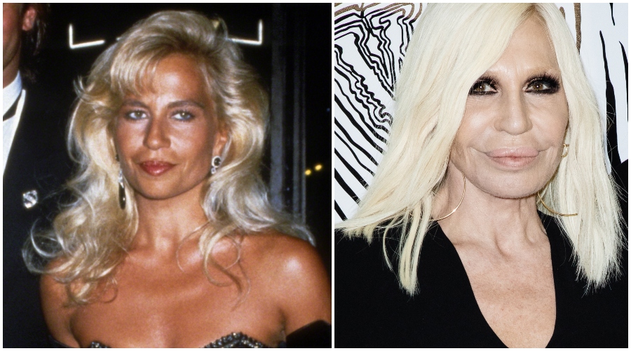 Transformaciones de los famosos: quién tiene más cirugías