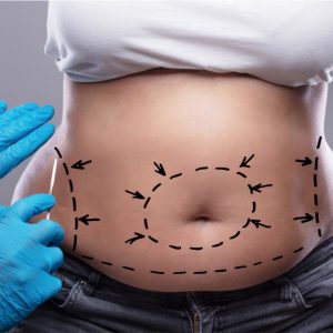 Cirugía de abdomen
