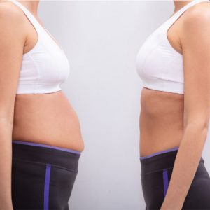 Antes y después de una cirugía de abdomen